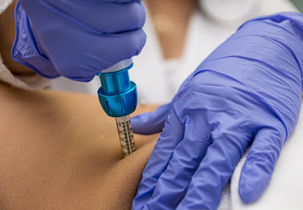 Tratamento Intradermo para Ansiedade por Doces