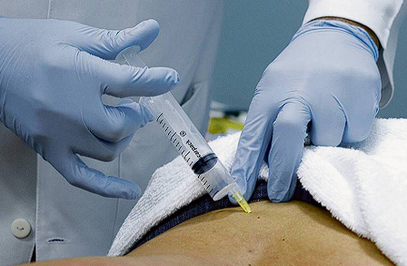 Ozonioterapia Fascial