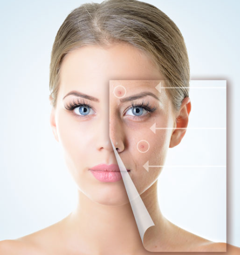 Tratamento de Verrugas com Laser (BLAUMAN)
