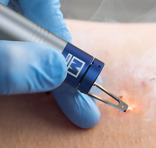 Tratamento Lesões Benignas, Fibroma Mole e Manchas Senis com Laser (BLAUMAN)