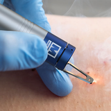 Tratamento Lesões Benignas, Fibroma Mole e Manchas Senis com Laser (BLAUMAN)